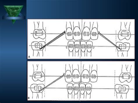 Finishing And Detailing In Orthodontic Treatment Certified Fixed Orthodontic Courses By Indian