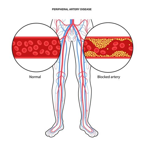 Pad Symptoms And Causes Premier Vascular Vein Center Tn