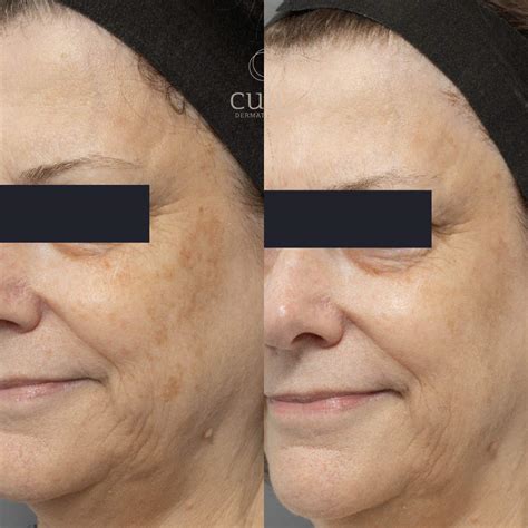 Pico Laser Pigment Removal Cutis Dermatology