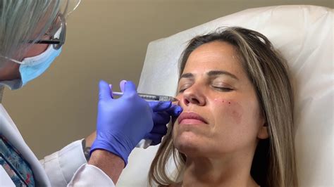 Cheeks And Nasolabial Folds Treatment With Dermal Filler At Well Medical Arts Youtube