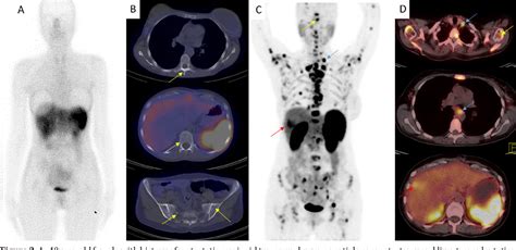 PDF Diagnostic Efficiency Of 68Ga DOTATATE PET CT As Compared To