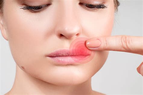 Angular Cheilitis Vs Cold Sore Ph