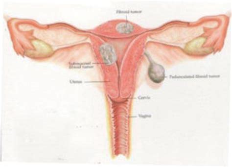 Uterine Polyps