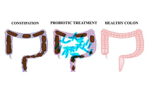 Treatment Of Constipation With Probiotics Lactobacillus Feces In