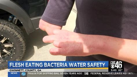 Woman Loses Limbs To Flesh Eating Bacteria Youtube