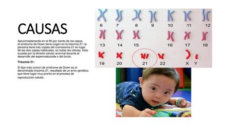 Causas Del Síndrome De Down Síndrome De Down Medicina Udocz