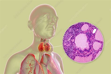 Toxic Goitre Of Thyroid Gland 3d Illustration Stock Image F042
