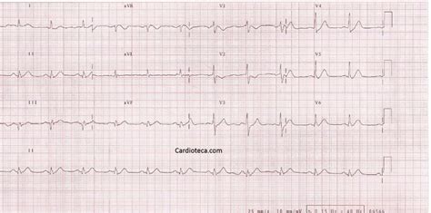 Curso Ecg Infarto Agudo Posterior