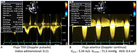 Impacto De La Presión Arterial Sanguínea En La Valoración Hemodinámica