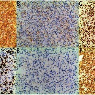 Immunohistochemical Staining The Tumor Showed Diffuse Immunoreactivity