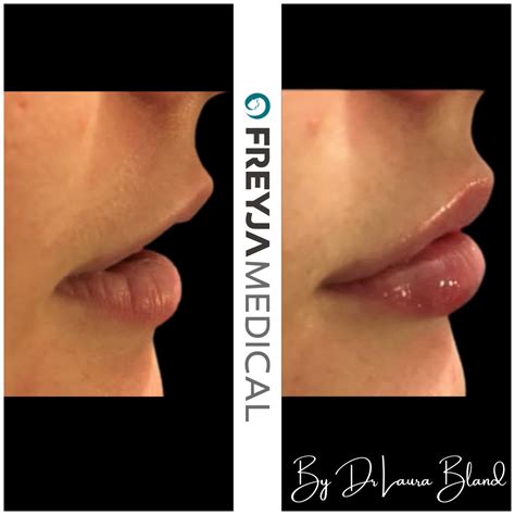 Lip Filler Before And After Freyja Medical