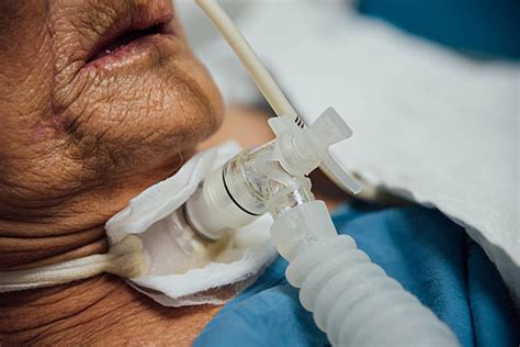 Patient Do Tracheostomy And Ventilator In Hospital Hospital