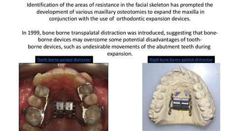 Surgically Assisted Rapid Palatal Expansion Sarpe