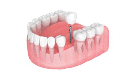 The Mini Dental Implant Process