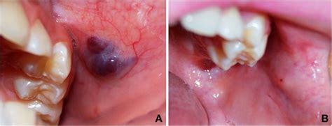 Monoethanolamine Oleate Sclerotherapy For The Treatment Of Intraoral