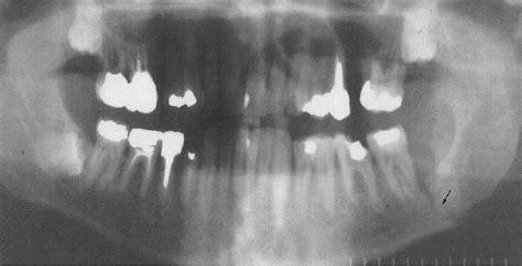 Mandibular Fractures | Semantic Scholar