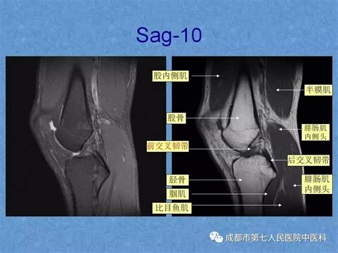 影像解剖 膝关节mri高清解剖图解 中国医疗