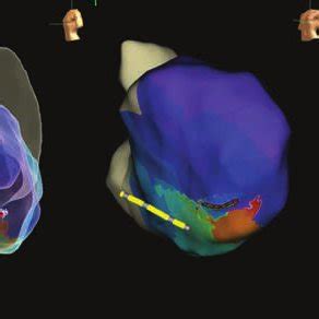 Mid Diastolic Electrogram During Vt Mapped With The Advisor Hd Grid