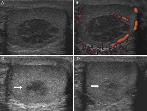 Segmental Testicular Infarction Conservative Management Is Feasible