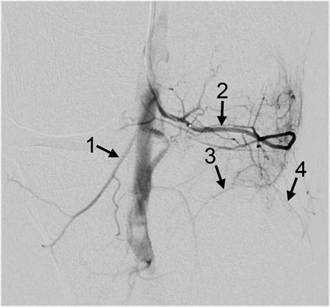 Genicular Artery Embolization A Review Of Essential Anatomic