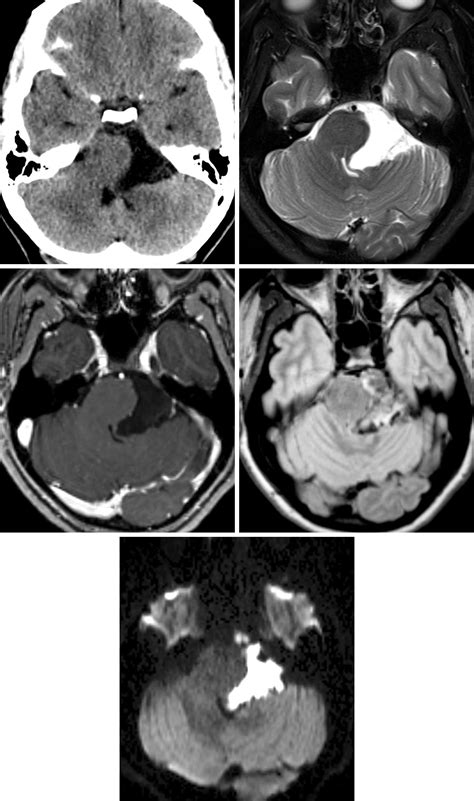 Epidermoid Cyst The Neurosurgical Atlas By Aaron Cohen Gadol M D