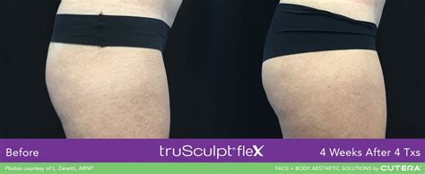 Miami S Trusculpt Flex Specialist 305 809 8352 Book Now