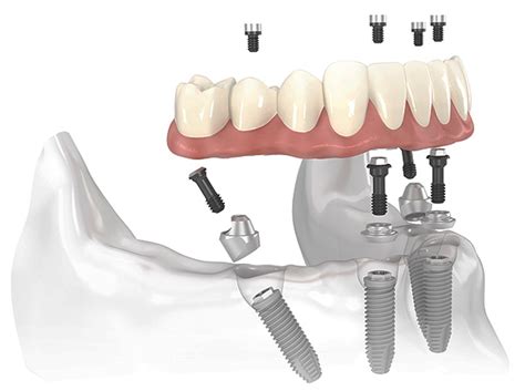 Implants Alpha Bio avis sur leur utilisation avantages et inconvénients