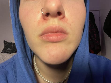 Redness Around Nose Rdermatologyquestions