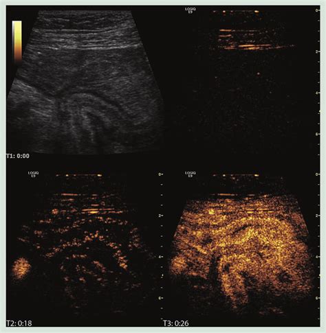 Contrast Enhanced Ultrasonography Of The Gastrointestinal Wall A