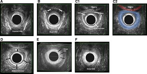 Normal Anal Sphincter