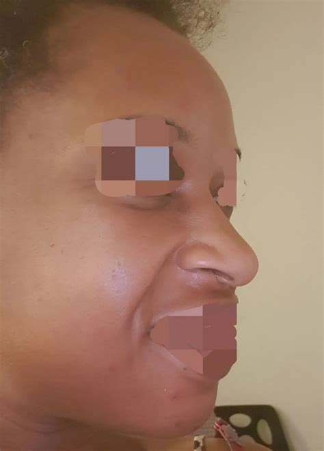 Pointe de nez tombante Rhinoplastie médicale ou correction du nez par