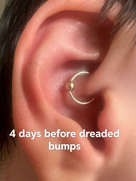 Irritation Bump Keeps Growing R Piercing