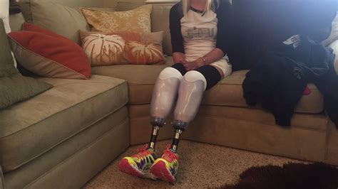 Amputee Gets Prosthetic Legs From Communitys Support