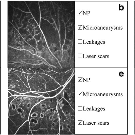 Examples Of The FFA Images With Different Kinds Of Lesions A Image