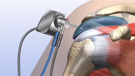 How Long Does It Take To Recover From Arthroscopic Shoulder