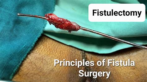 Fistulectomy Principles Of Fistula Surgery Hd P Dr Tayyab