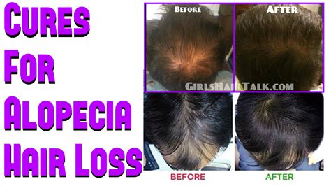 Cures For Alopecia Do They Really Work With Before And After Pictures