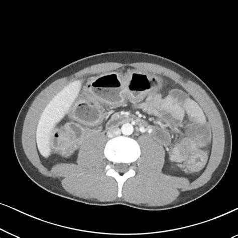 Radiopaedia Case Ulcerative Colitis Id Study Nc Commons