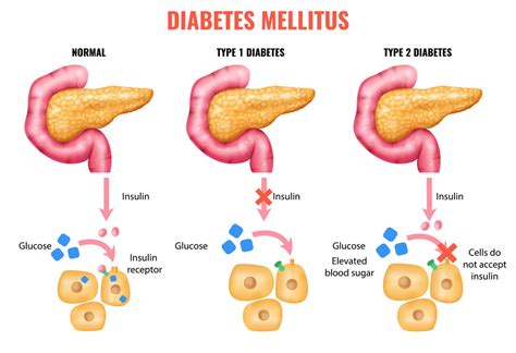 What You Need To Know Stages Of Type Diabetes Diabetes