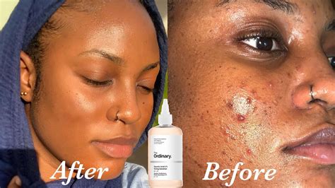 THE ORDINARY GLYCOLIC ACID 7 TONING SOLUTION INDEPTH REVIEW I Used