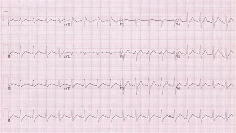 Ekg Examples Torrey Ekg