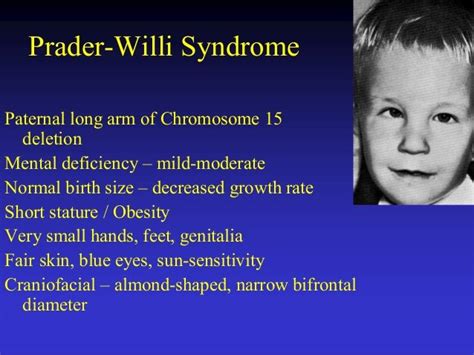 Prader Willi Syndrome Eyes Implantation Of Embryo 3 Medical