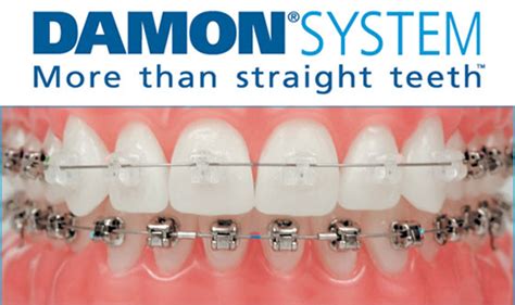 Morristown Orthodontics The Damon System