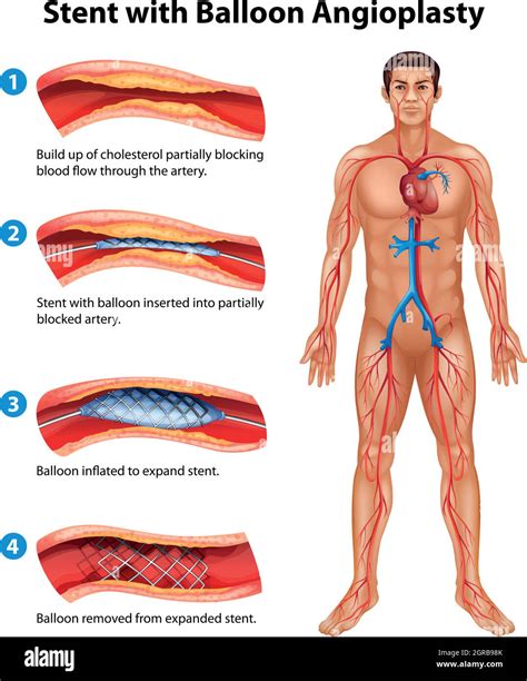 Coronary angioplasty Stock Vector Images - Alamy