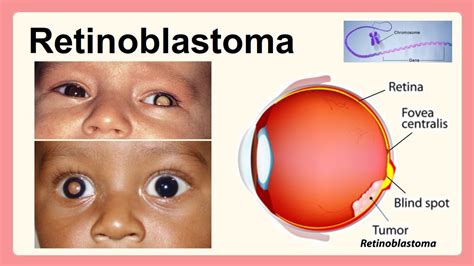 Retinoblastoma Youtube