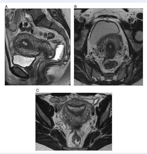 Structure Of Uterosacral Ligament Semantic Scholar