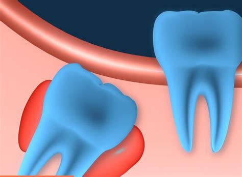 Full list of 6 dental cyst types. What is a cyst on a tooth? How ...