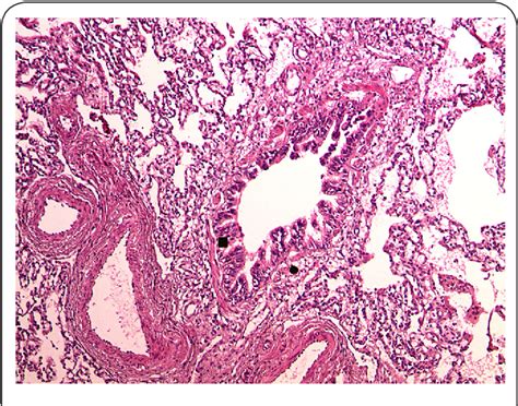 Figure From Case Of Congenital Lobar Lung Emphysema Semantic Scholar