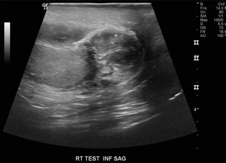 Epididymo-orchitis | Radiology Case | Radiopaedia.org