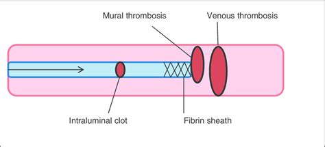 Schematic Image Of Thrombotic Events That May Be Associated With Download Scientific Diagram